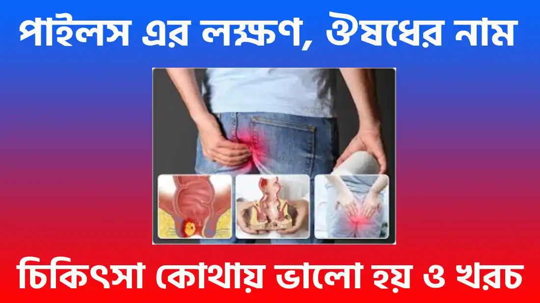 পাইলস এর লক্ষণ, চিকিৎসা, ঔষধের নাম, চিকিৎসা খরচ